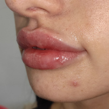 Збільшення губ