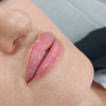 Корекція губ при неправильному прикусі