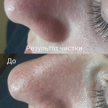 До/після чистки обличчя