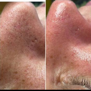 До/після чистки обличчя