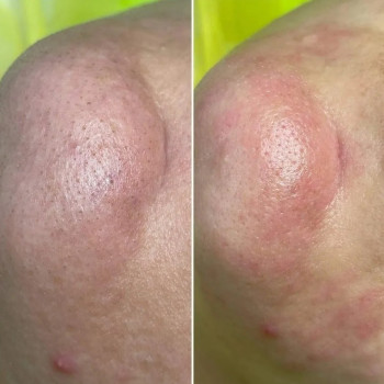 До/після чистки обличчя