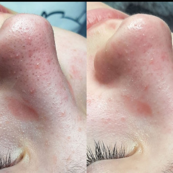 До/після чистки обличчя