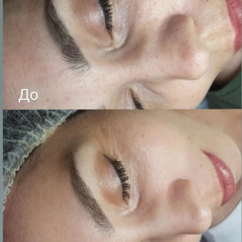 Карбокситерапія
                    Косметолог-естетист Анна Полтава