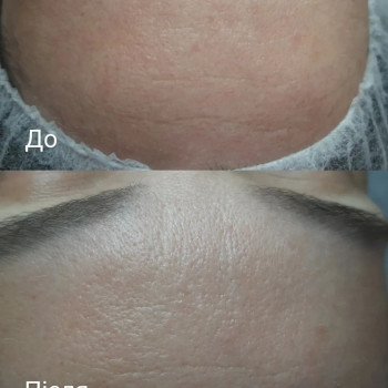 Карбокситерапія
                    Косметолог-естетист Анна Полтава