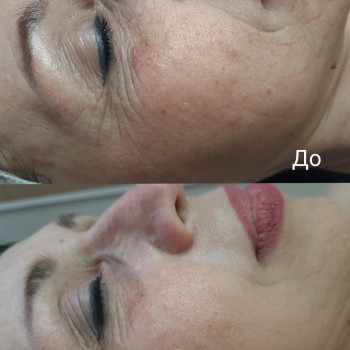 Зменшення мімічних зморшок за рахунок зволоження і ліфтингу