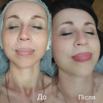 Покращення кровообігу шкіри і зміна тону