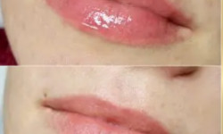 Мезотерапія губ "SEXY LIPS" Косметолог-эстетист Светлана Харьков