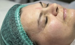Пілінг Косметолог Татьяна Київ