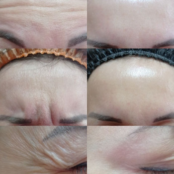 Верхня третина