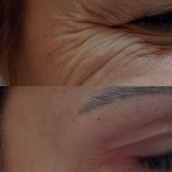 Терапія зморшок новколо очей