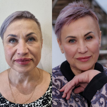 Ботокс фул фейс