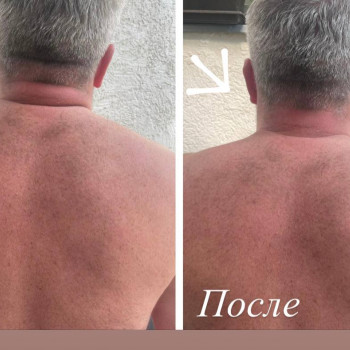 Лікування спазмованої шії