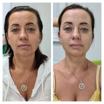 Ботулінотерапія
                    Косметологический центр Cosmo Beauty Киев