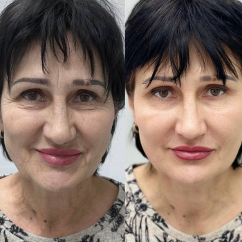 Ботулінотерапія та біорепарація