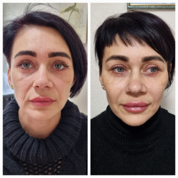 Контурна пластика