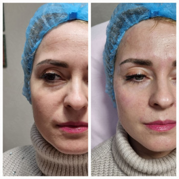 Контурна пластика