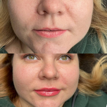 Контурна пластика губ