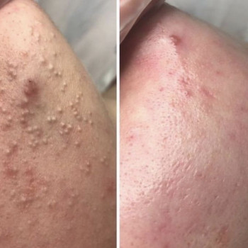 Чистка обличчя
                    Дерматолог косметолог Анастасия Славута