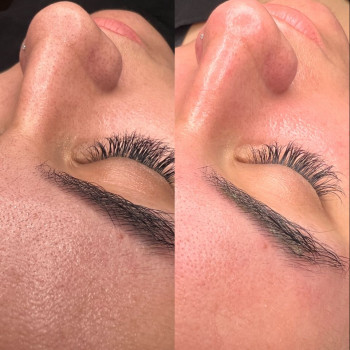 Чистка обличчя
                    Дерматолог косметолог Анастасия Славута