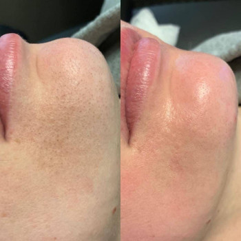 Чистка обличчя
                    Дерматолог косметолог Анастасия Славута