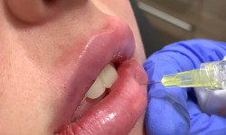 Збільшення губ Дерматолог косметолог Анастасия Славута