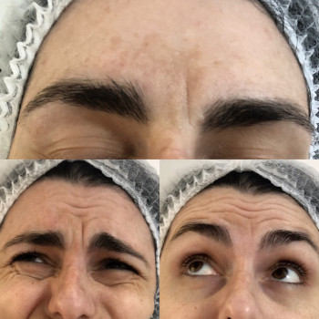 Верхня третина обличчя