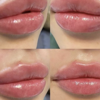 Первинна корекція