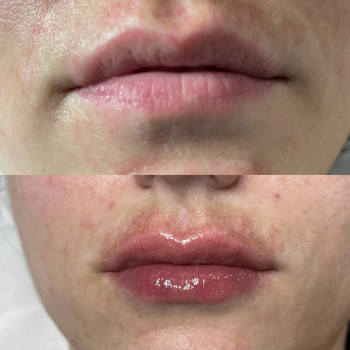 Відновлення фізіологічного контуру та обʼєму