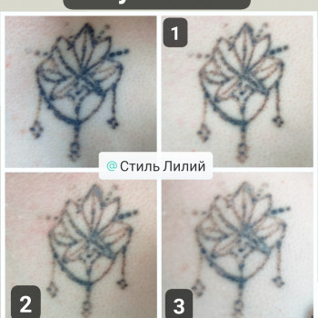 Лазерне видалення тату і татуажу
                    Косметологический центр Стиль Лилий Нежин