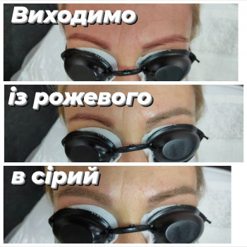 Лазерне видалення тату і татуажу
                    Косметологический центр Стиль Лилий Нежин