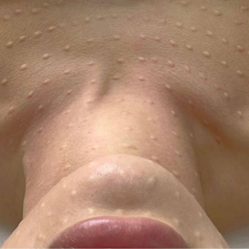 Біоревіталізація