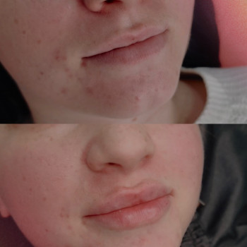 Контурна пластика губ
                    Косметолог-инъекционист Даниэла Черкассы