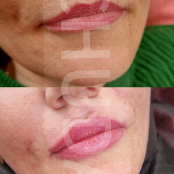 Контурна пластика губ
                    Косметолог-инъекционист Даниэла Черкассы