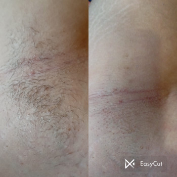 Вперше в житті процедура депіляції пахви.