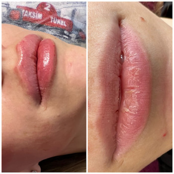 Контурна пластика губ
                    Врач-косметолог Екатерина Чернигов