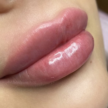 Контурна пластика губ
                    Врач-косметолог Екатерина Чернигов