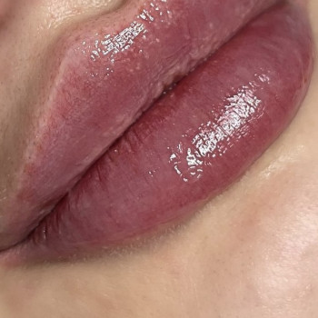 Контурна пластика губ
                    Врач-косметолог Екатерина Чернигов