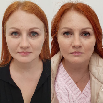 Ботокс full face