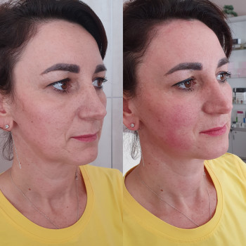 Контурна пластика
                    Лікар-косметолог Оксана Київ