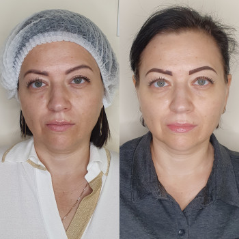 Контурна пластика
                    Лікар-косметолог Оксана Київ