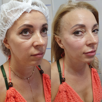 Контурна пластика
                    Лікар-косметолог Оксана Київ