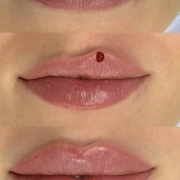 Збільшення губ, аугментація губ
                    Дерматолог косметолог Оксана Киев