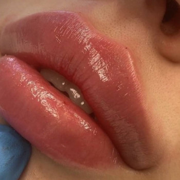 Збільшення губ, аугментація губ
                    Дерматолог косметолог Оксана Киев