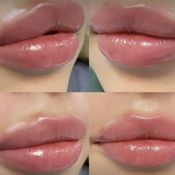 Збільшення губ, аугментація губ
                    Дерматолог косметолог Оксана Киев