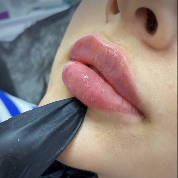 Збільшення губ, аугментація губ
                    Дерматолог косметолог Оксана Киев