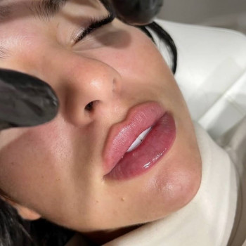 Збільшення губ, аугментація губ
                    Дерматолог косметолог Оксана Киев