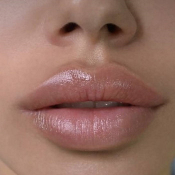 Збільшення губ, аугментація губ
                    Дерматолог косметолог Оксана Киев