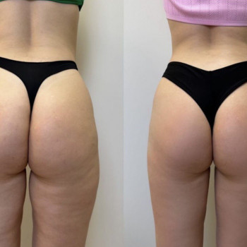 Моделюючий масаж
                    Масажист Денис Київ