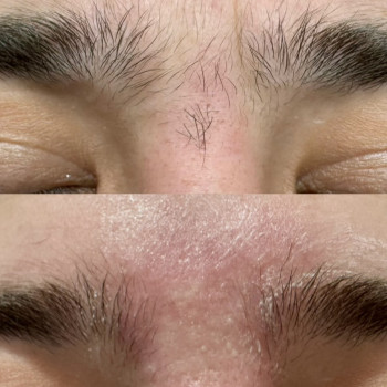 Електроепіляція
                    Электролог Лилия Киев