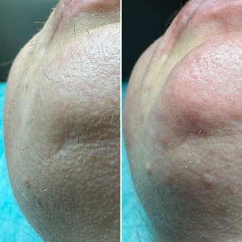 Електроепіляція
                    Электролог Лилия Киев